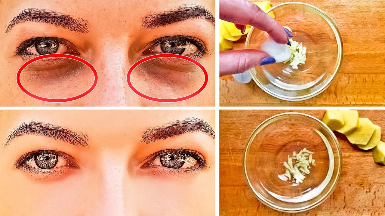 How To Get Rid Of Black Circles Under Your Eyes