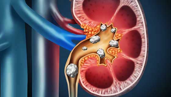 Signs Of Kidney Stone 1a
