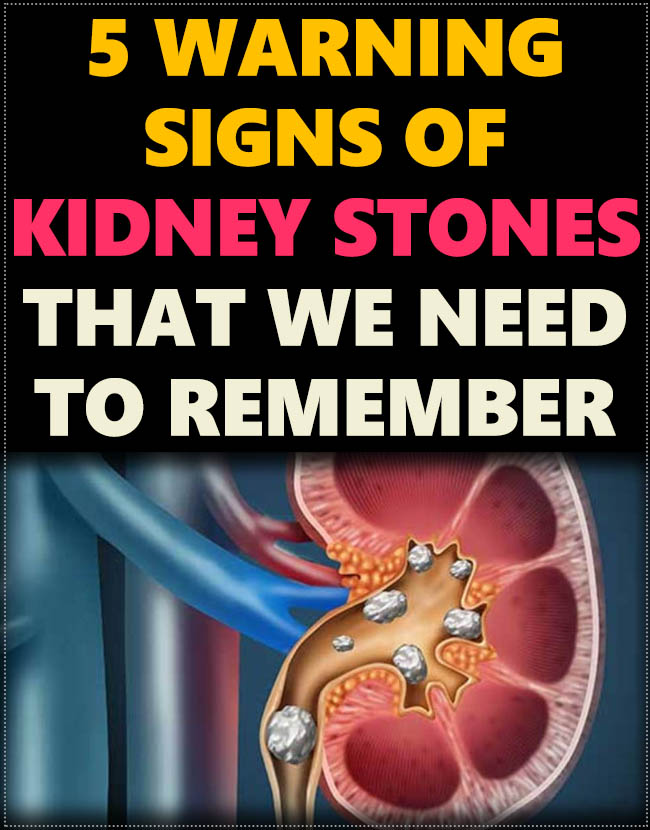 5 Warning Signs of Kidney Stones That We Need to Remember 2