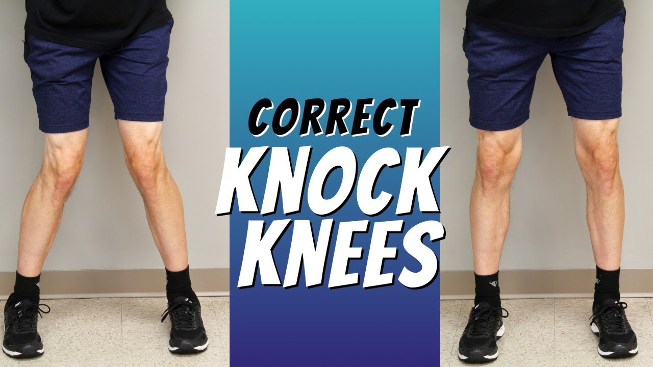 Top 5 Ways to Correct Knock Knees with Exercise Etc. 