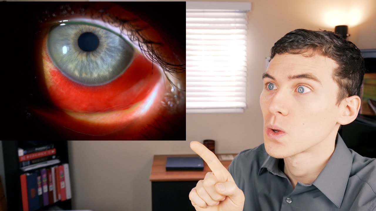 Bloodshot Eyes | What Causes Bloodshot Eyes and How to Get Rid of Them | Doctor Eye Health 