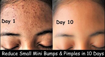 Get rid of Tiny Bumps on Face – Small head bumps & Pimples | Clear Skin with Ice cubes massage