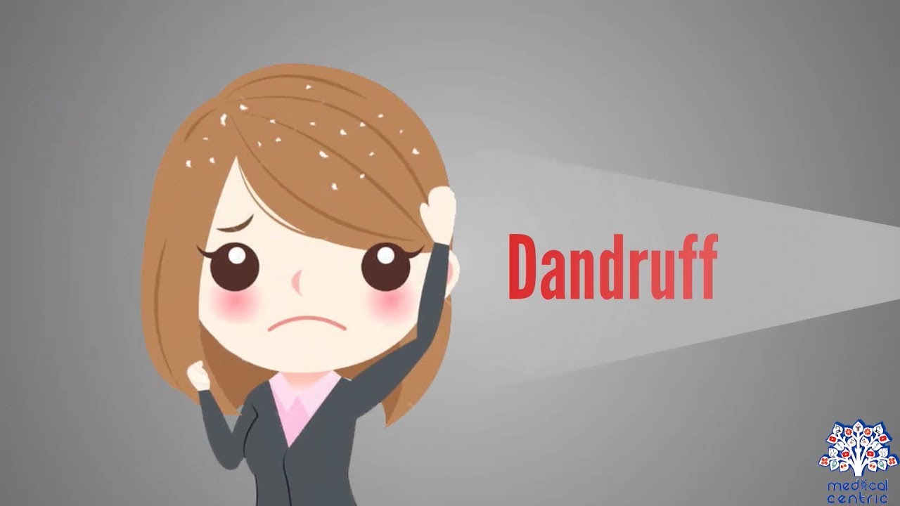 Dandruff, Causes, Signs and Symptoms, Diagnosis and Treatment. 