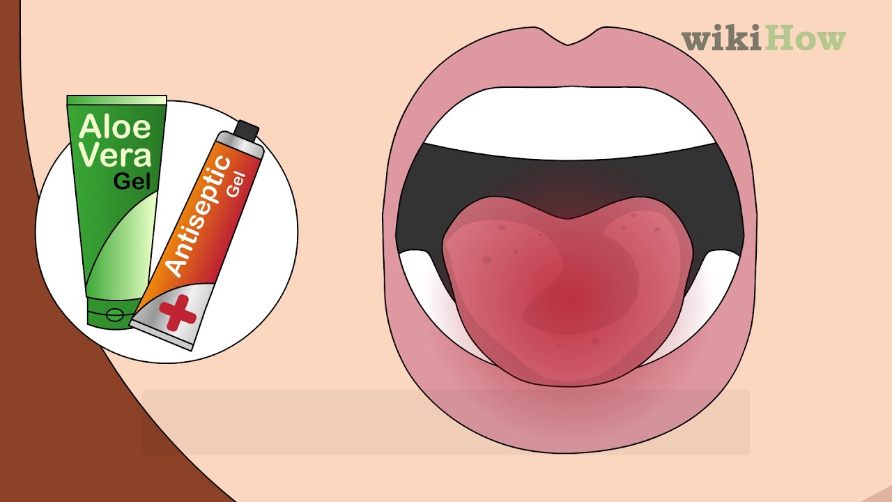 How to Heal a Bitten Tongue 