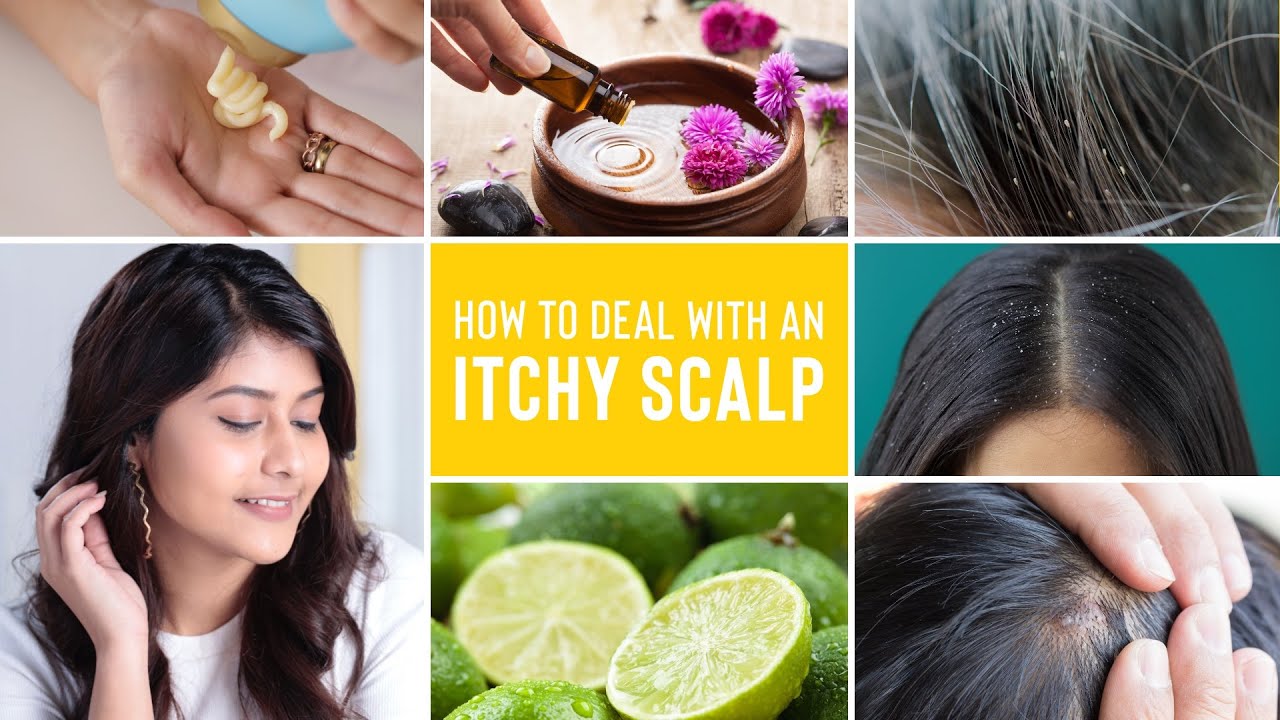 Itchy Scalp Treatments | Remedies For Dandruff, Lice and Scalp Acne 