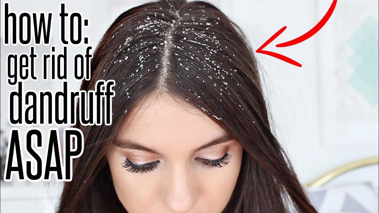 What is dandruff and how to get rid of it