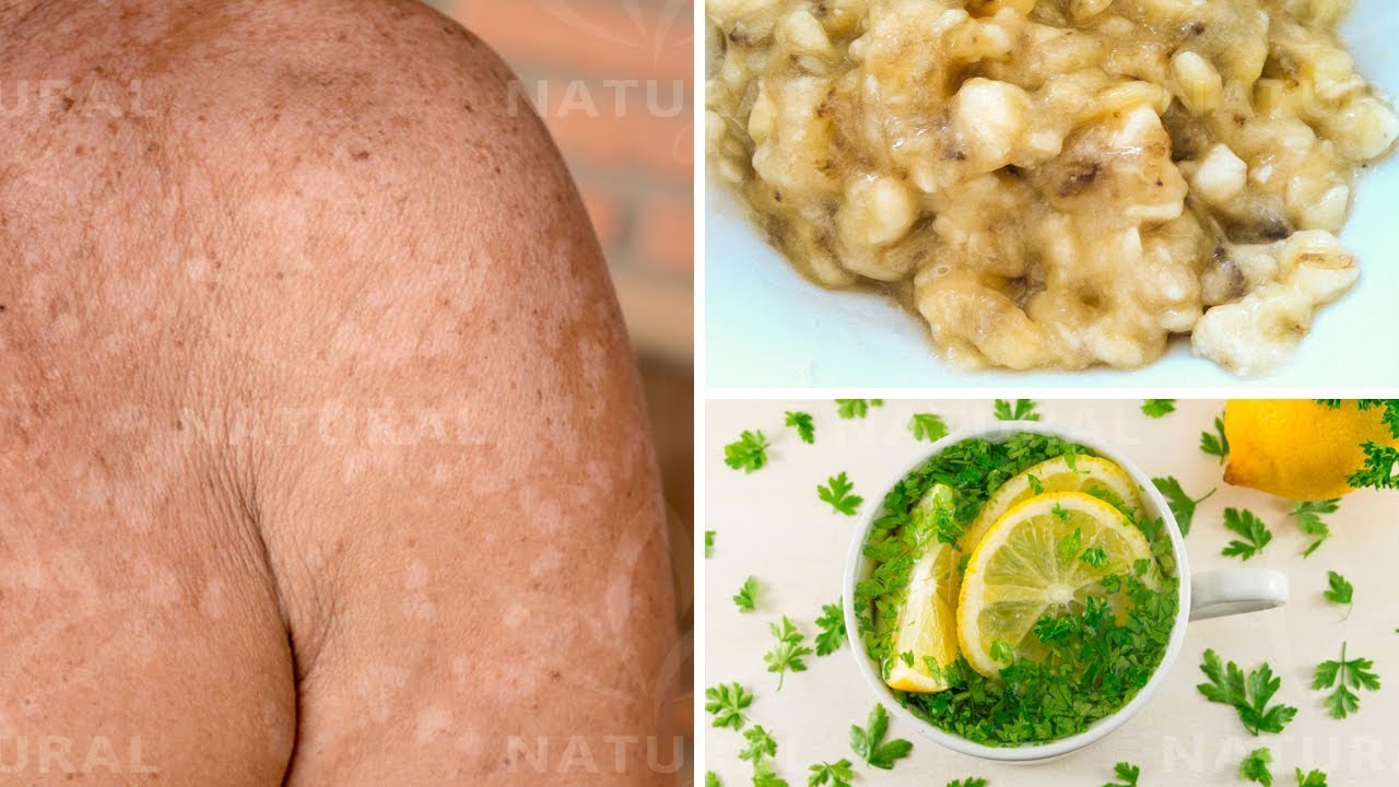 3 Natural Remedies for Treating Tinea Versicolor at Home (Pityriasis Versicolor) 