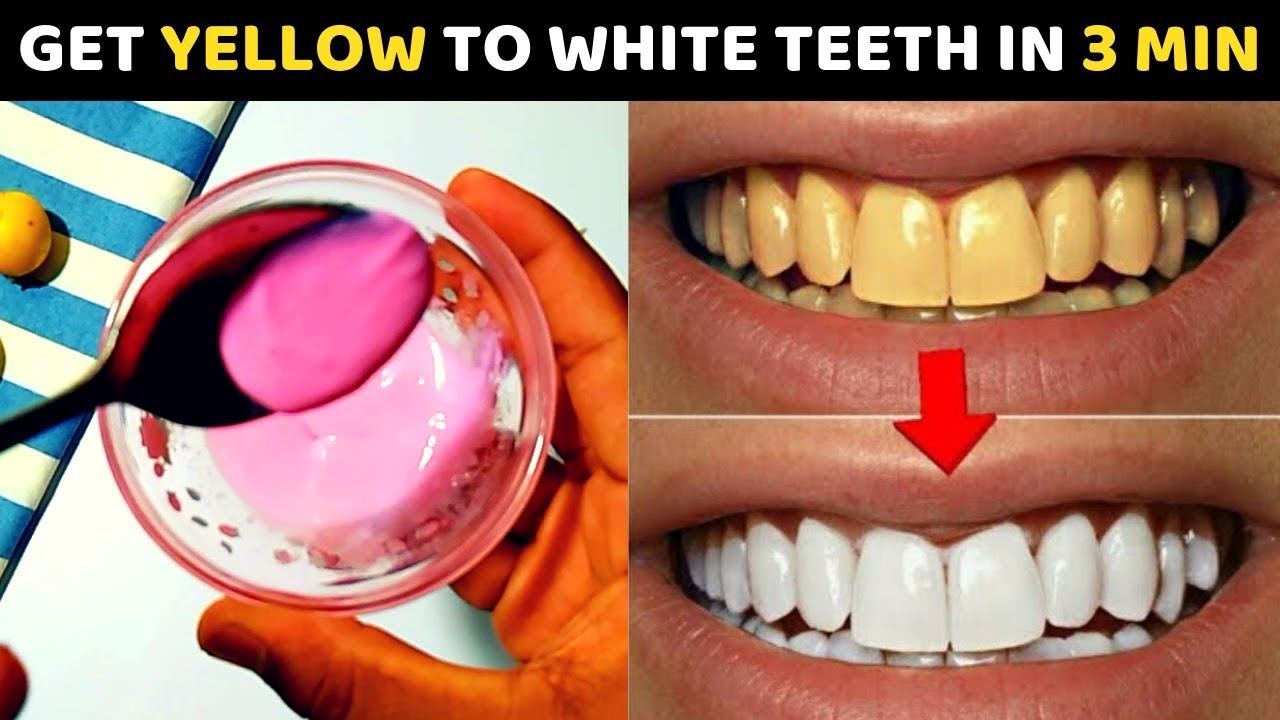 How to Make Teeth Whiter in 3 Minutes Naturally From Yellow – Home Remedy That Work Instantly 