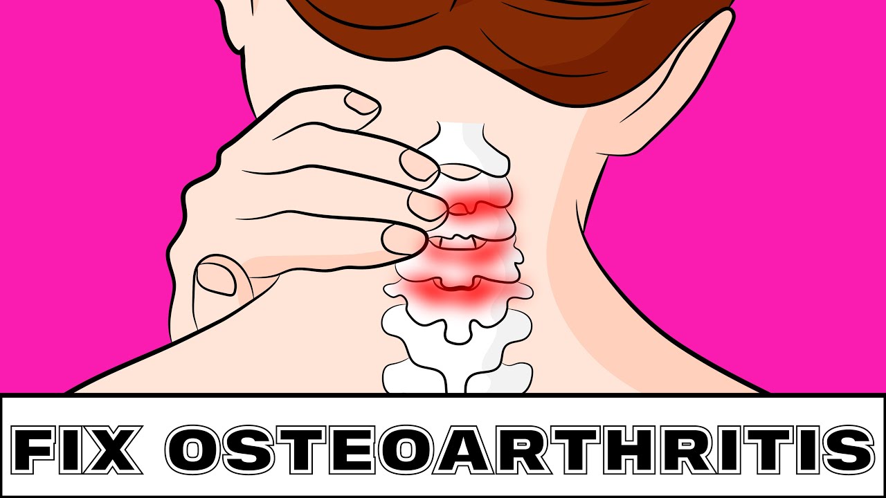 How to Stop Neck Pain from Osteoarthritis in 3 minutes! 