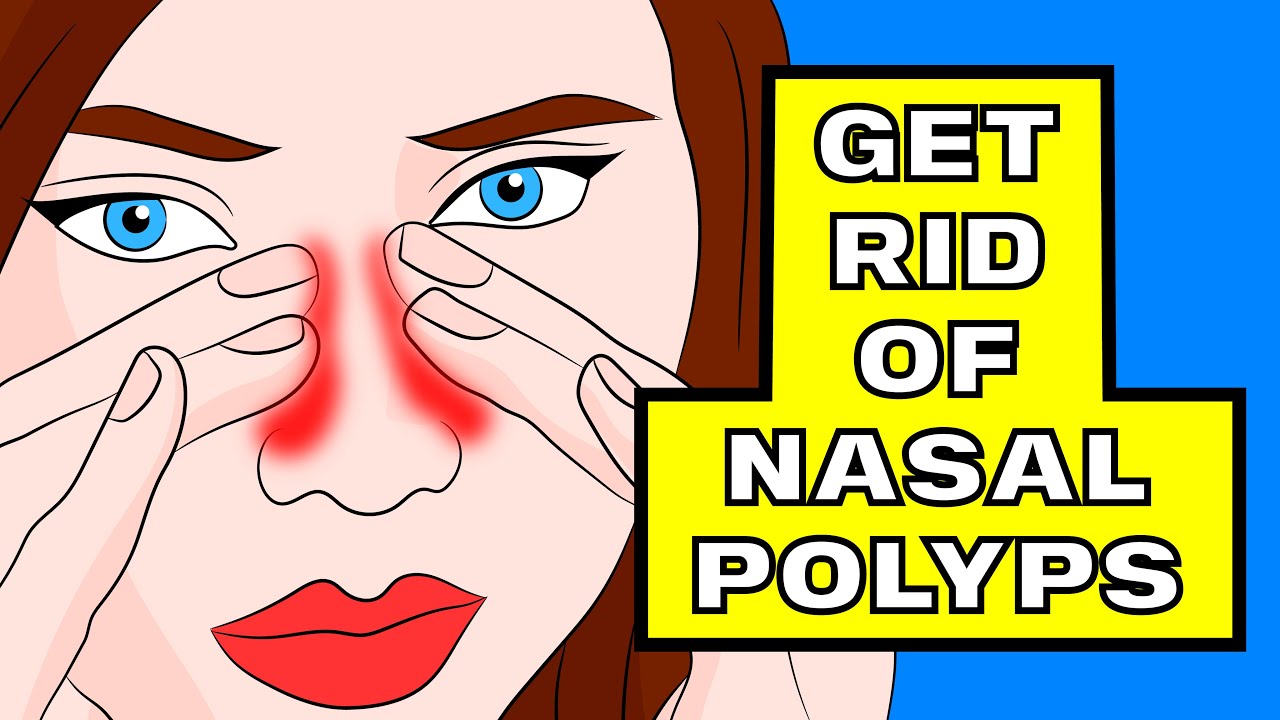 How to Shrink your Nasal Polyps in under 3 minutes WITHOUT surgery 