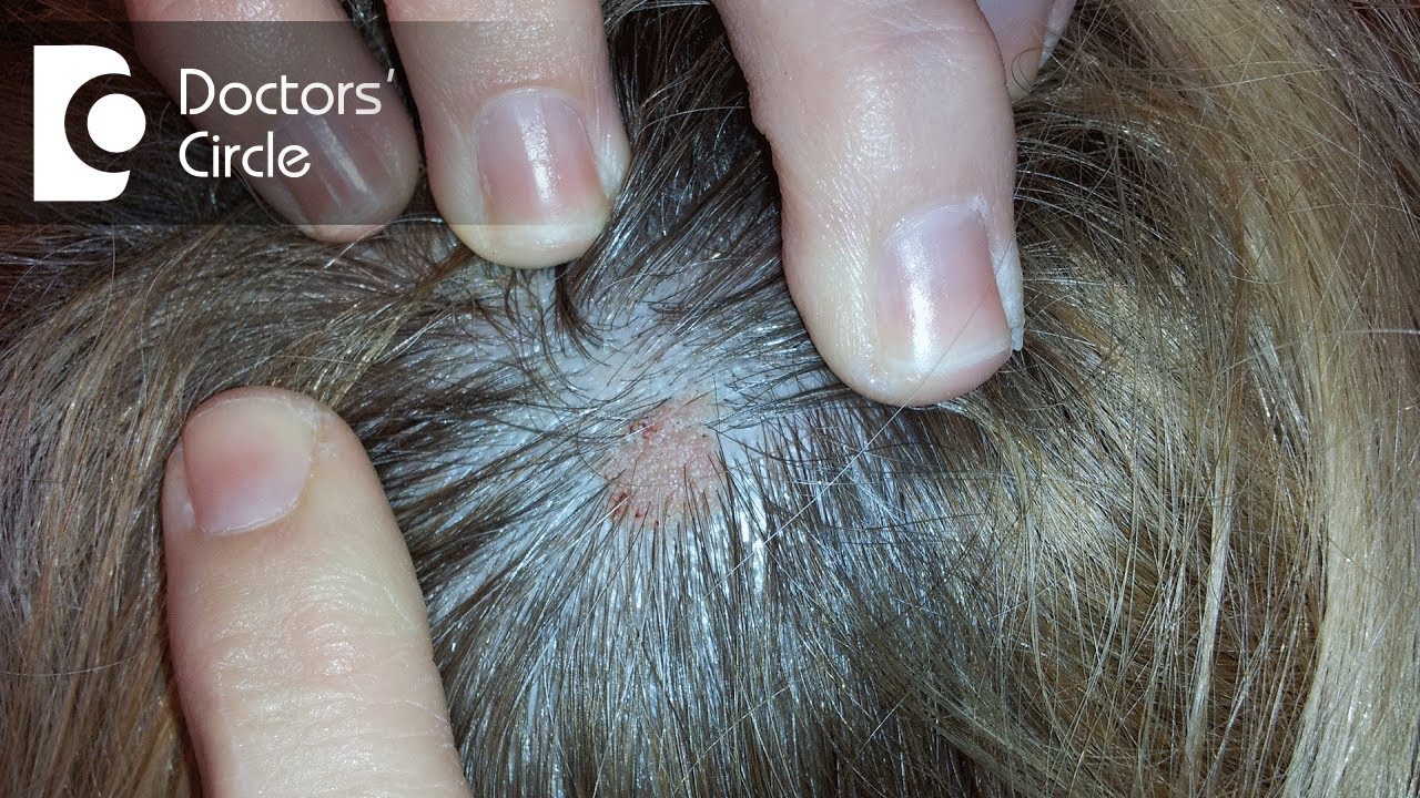 What does small skin colored lump on the scalp indicate? - Dr. Urmila Nischal 