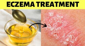 Cure infected eczema permanently, fast at home on hands fingers and face Natural remedy