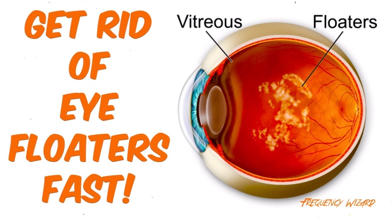 GET RID OF EYE FLOATERS FAST! HAVE CLEAR VISION - TREATMENT CURE - EYE FLOATERS REMOVAL - NO SURGERY 