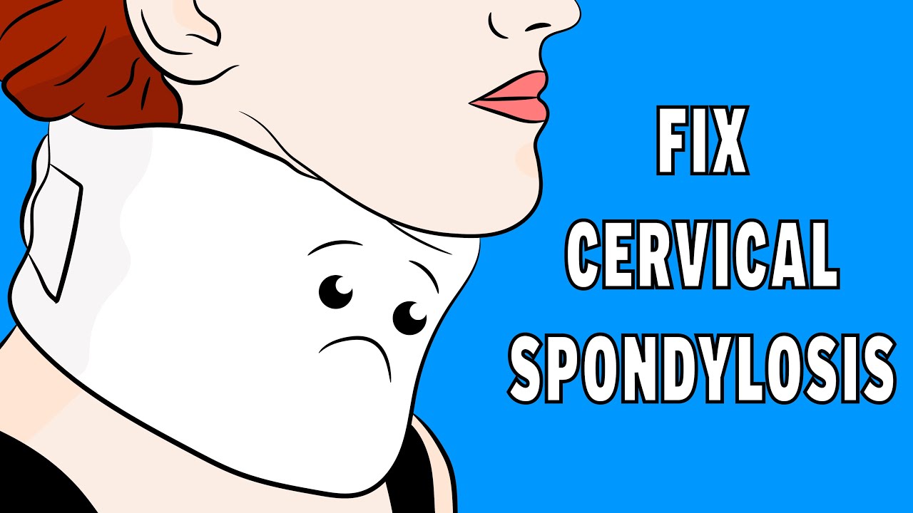 How to fix Cervical Spondylosis Neck Pain in 3 minutes 