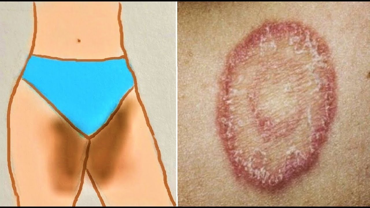 How to treat Private Part Itching, Fungal infection, burning, Yeast infection - Home Remedies 