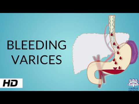 BLEEDING VARICES, Causes, Signs and Symptoms, Diagnosis and Treatment. 