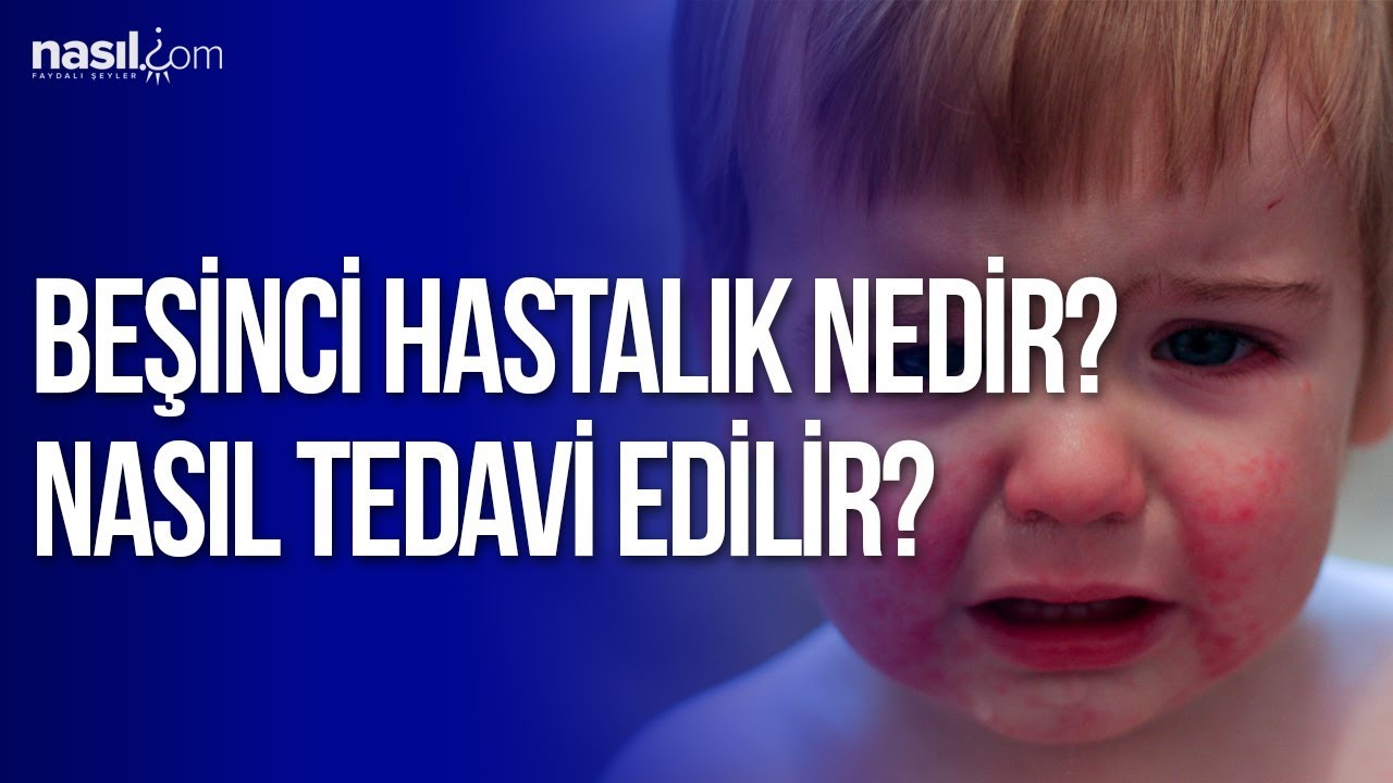 Beşinci Hastalık Nedir? Nasıl Tedavi Edilir? 