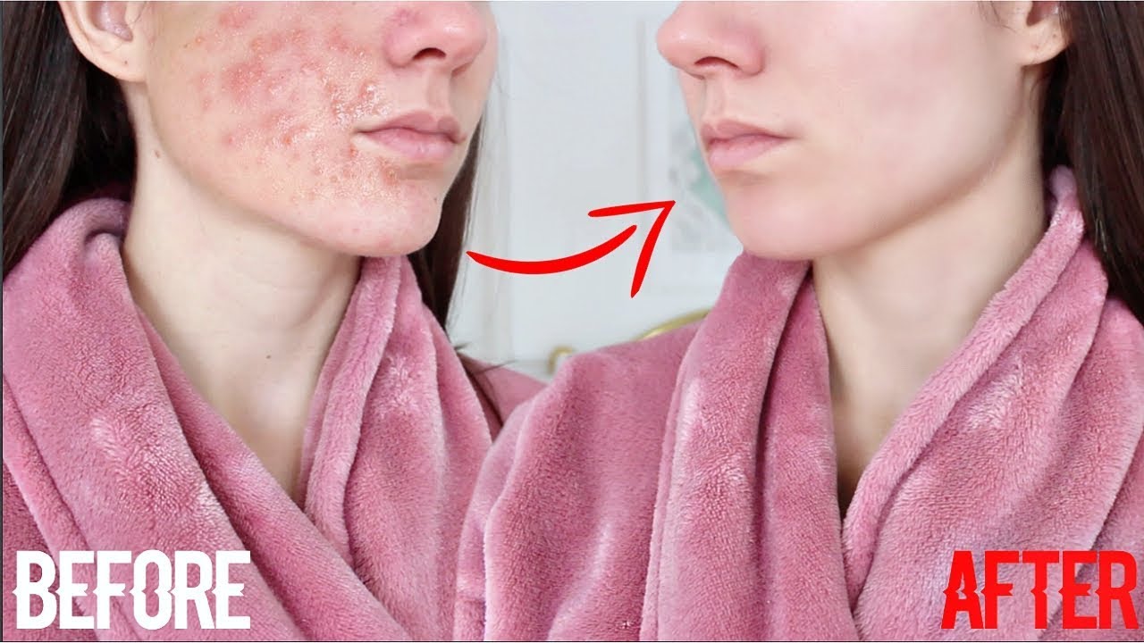 How To Get Clear Skin FAST ! The REAL WAY ! 