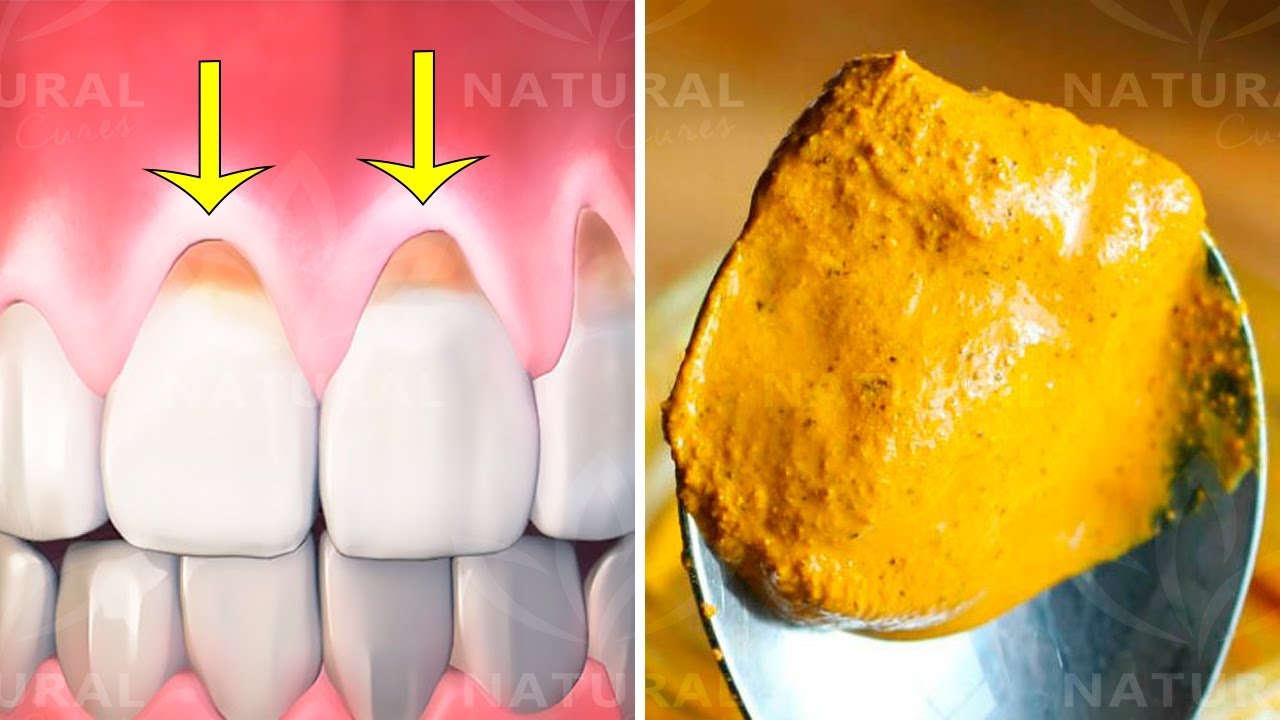 Why Turmeric is Fantastic for Oral Health and Hygiene 2