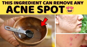 Use Tea Tree Oil for Acne Spot Overnight Treatment – DIY Natural Acne Scar Treatment