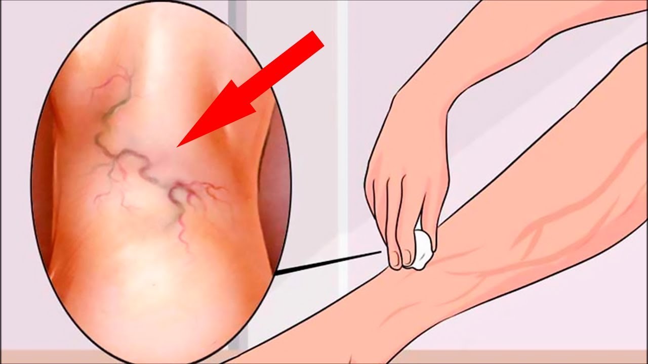 Get Relief from Varicose Veins With This Natural Treatment 