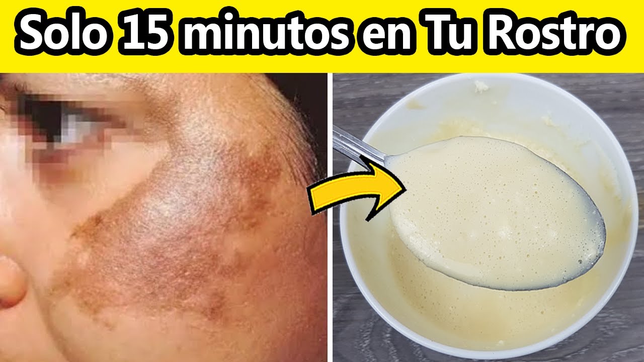 Solo 15 minutos en tu Rostro y Blanquea la piel, quita Cicatrices, acné y Puntos Negro. 