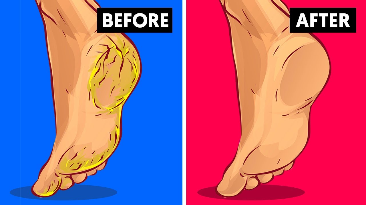 Home Remedy to Remove Cracked Heels Fast (Works Overnight) 