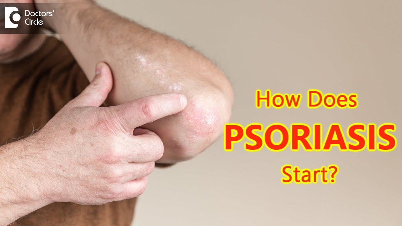 How does psoriasis start? Main Causes & Symptoms - Dr. Chaithanya K S | Doctors' Circle 
