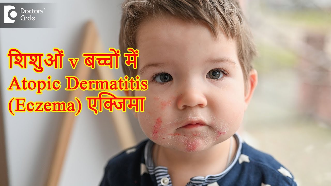 शिशुओं v बच्चों में Atopic Dermatitis (Eczema) एक्जिमा |खुजली का इलज| एक्जिमा उपचार-डॉ. रसया दीक्षित 