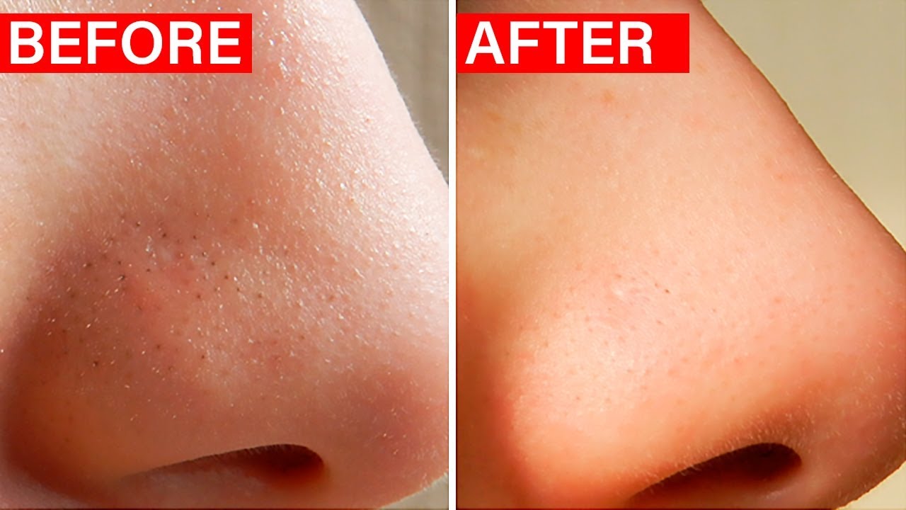 How To Get Rid Of Blackheads For Good (DIY Blackheads Face Mask) 
