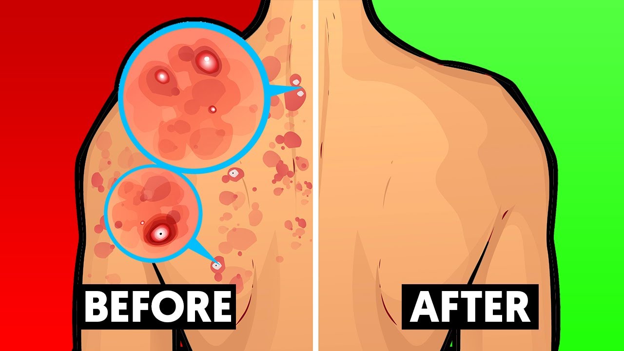 How To Get Rid of Back Acne Fast 