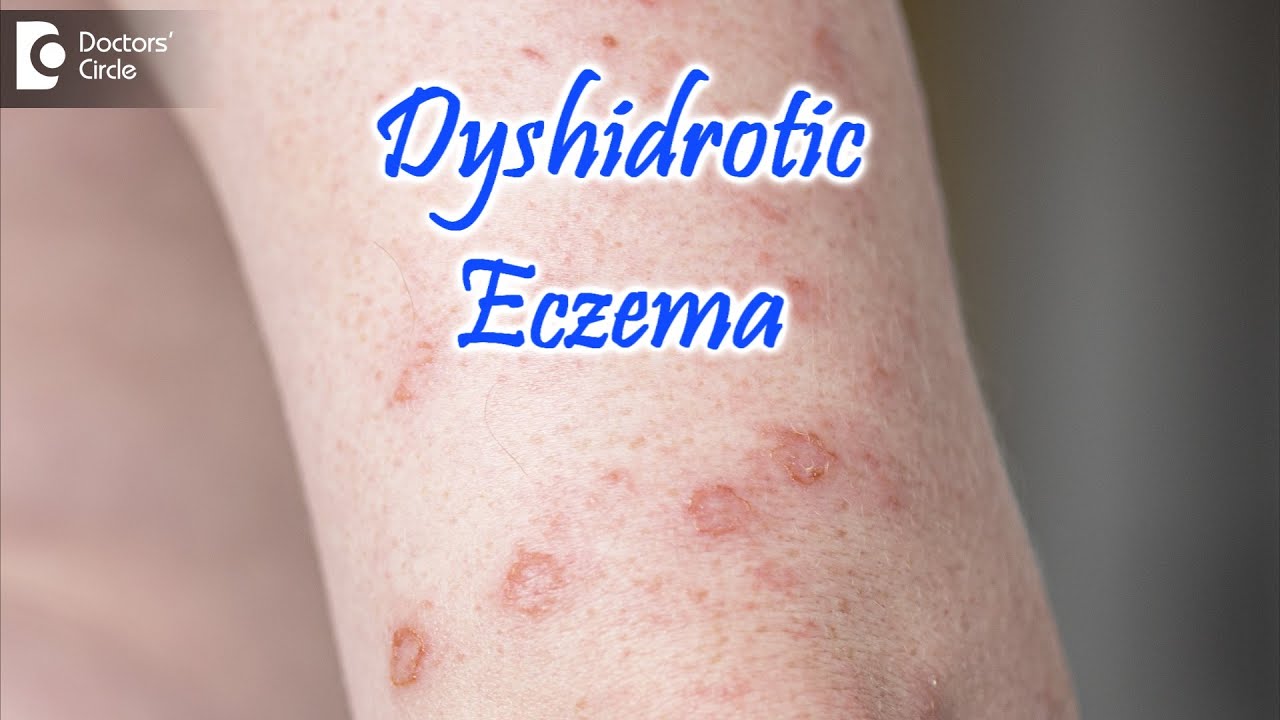 Dyshidrotic Eczema ( POMPHOLYX ) : Causes, Symptoms, & Treatment – Dr. Nischal K | Doctors’ Circle