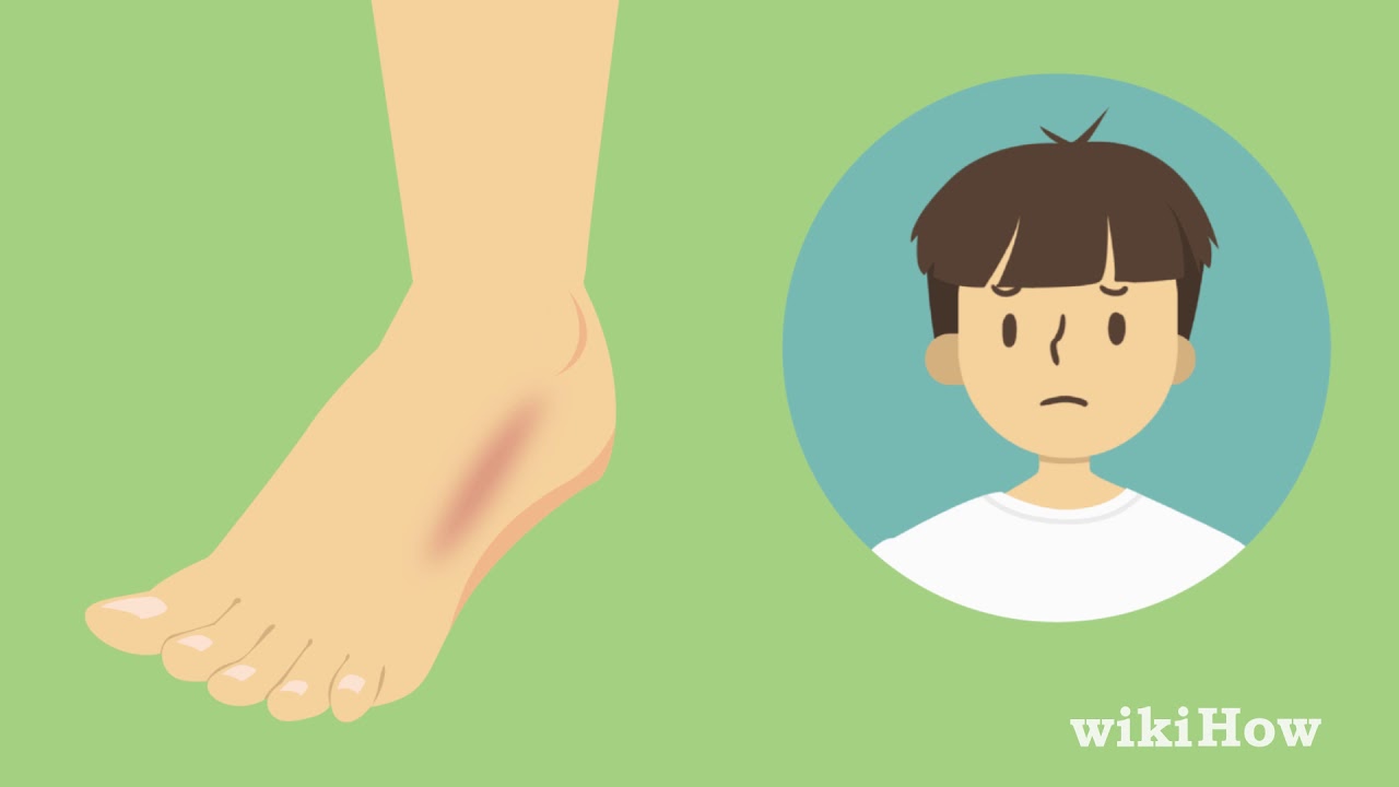 How to Tell if Your Foot Is Broken 