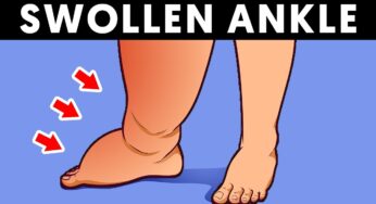 Warning: If Your Ankle is Swollen, Do This