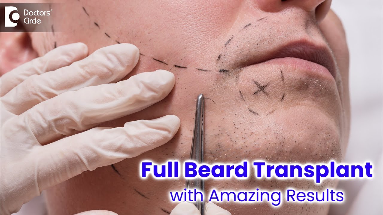 Full beard transplant with amazing results - Dr. Deepak P Devakar | Doctors' Circle 